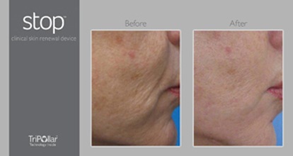 [before_after_cheek stopage[4].jpg]
